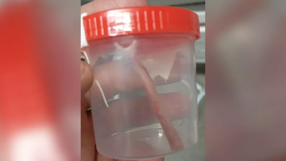 Pescador ferroado por cachara passa bem após cirurgia na Santa Casa de Campo Grande