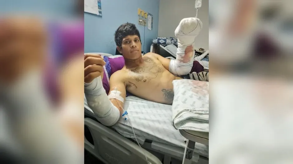 Trabalhador sofre descarga elétrica, tem mãos queimadas e teme perder movimentos 