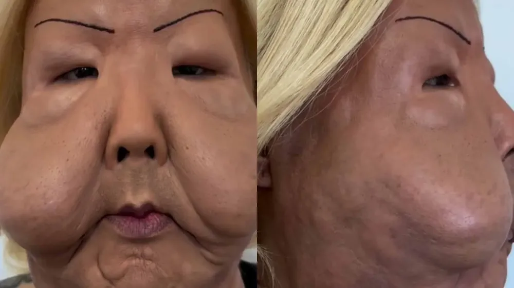 Mudou muito? Médico mostra como ficou Juju do Pix após retirada de óleo mineral do rosto